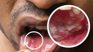 कैंसर के शुरुआती लक्षण जिन्हें लोग अक्सर नजरअंदाज कर देते हैं